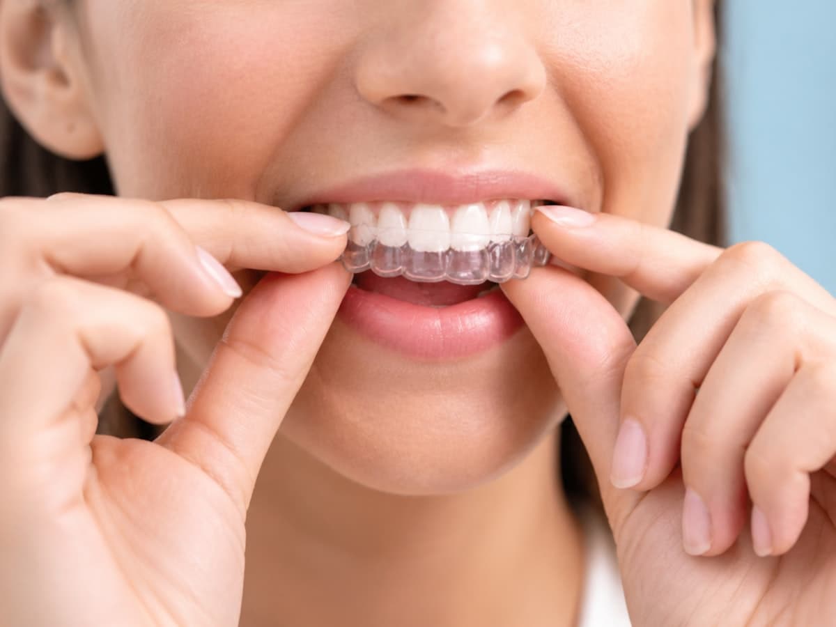Patient fitting clear dental aligners
